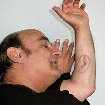 Stelarc's Extra Ear